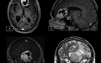 Caso del mes Febrero 2026