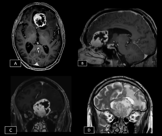 Caso del mes Febrero 2026