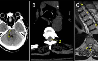Caso del mes Marzo 2026