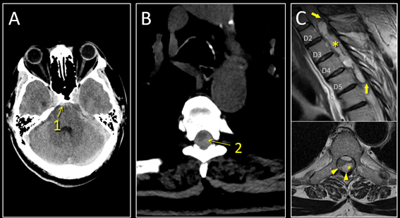 Caso del mes Marzo 2026